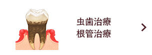 虫歯治療 根管治療