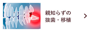 親知らずの 抜歯・移植