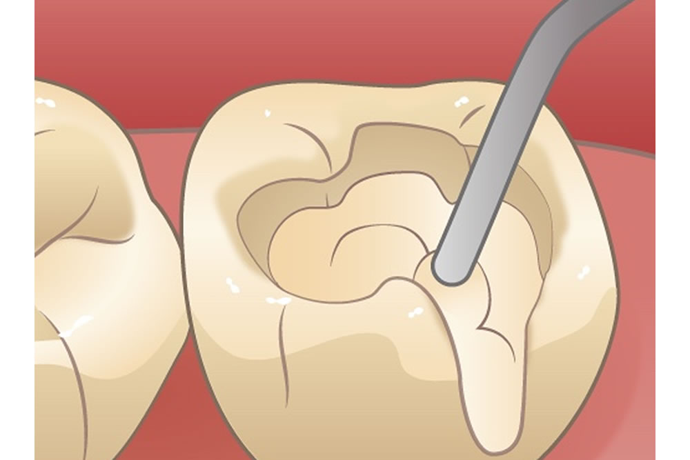 コンポジットレジン充填（保険診療）