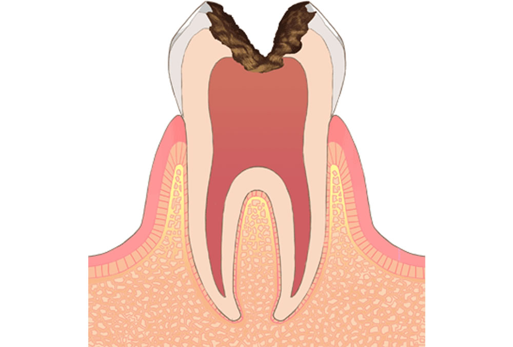 歯の神経まで進行した虫歯（C3）