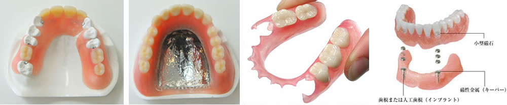 入れ歯の種類