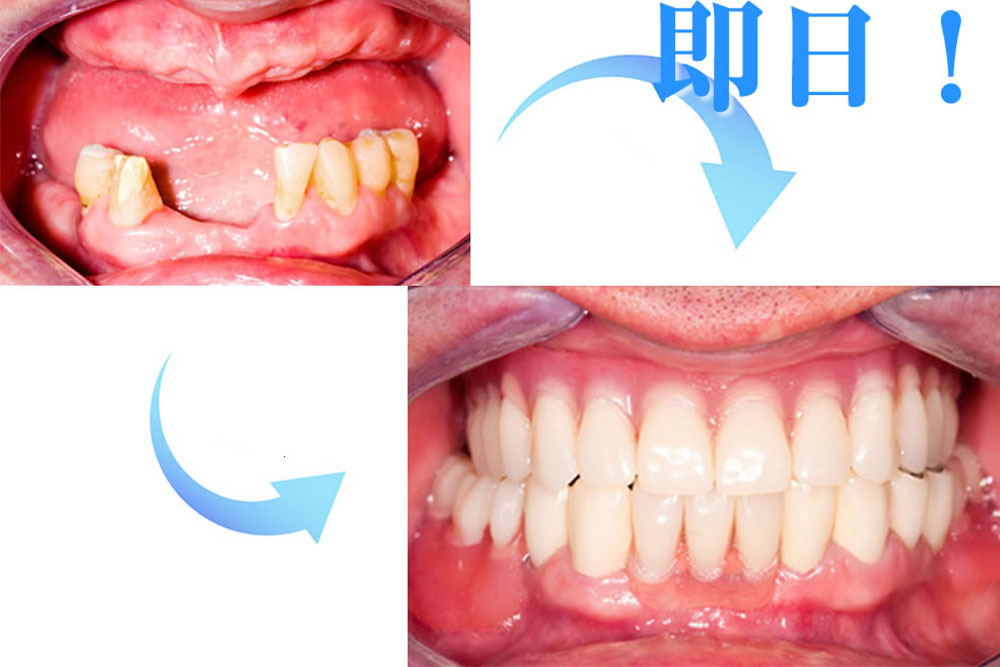 抜歯即時埋入インプラント
