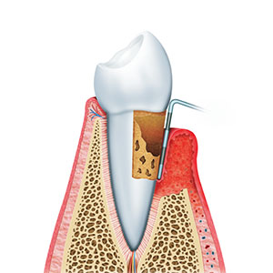 歯周病治療