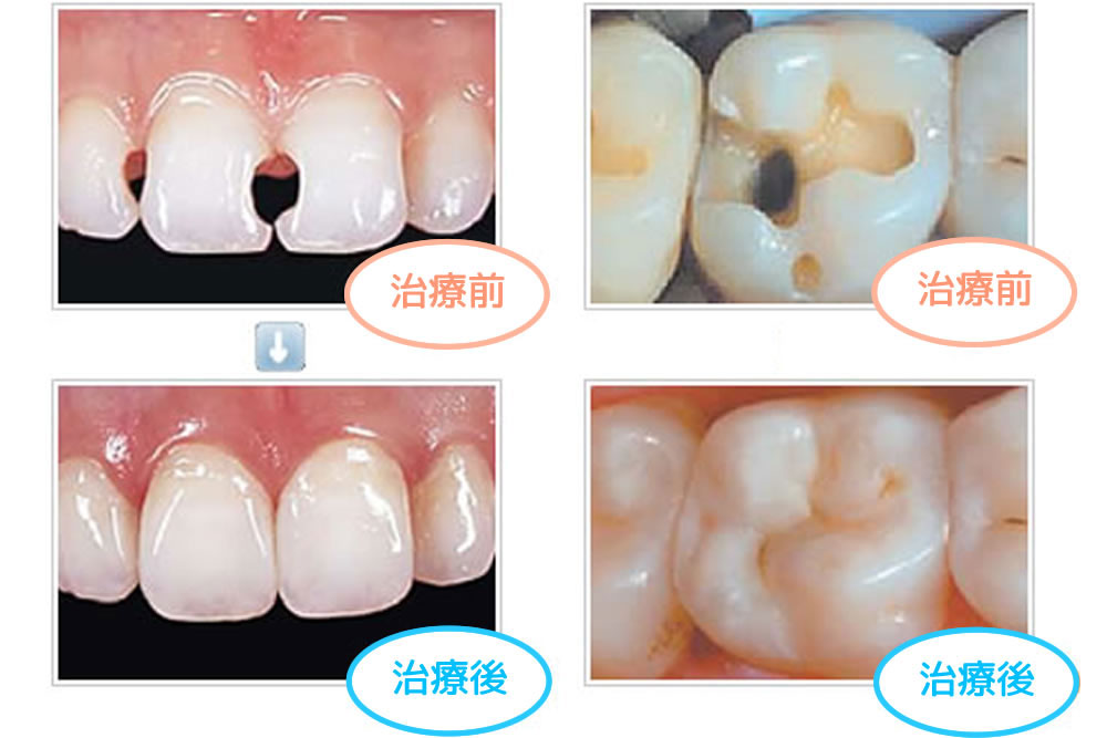 レジン充填による修復