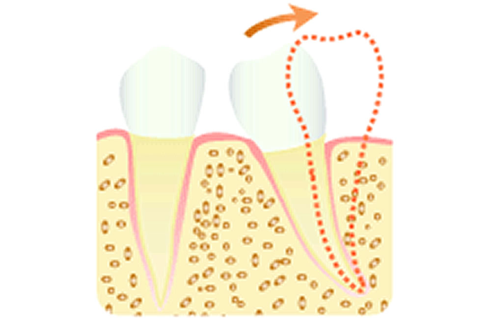 歯軸傾斜の改善