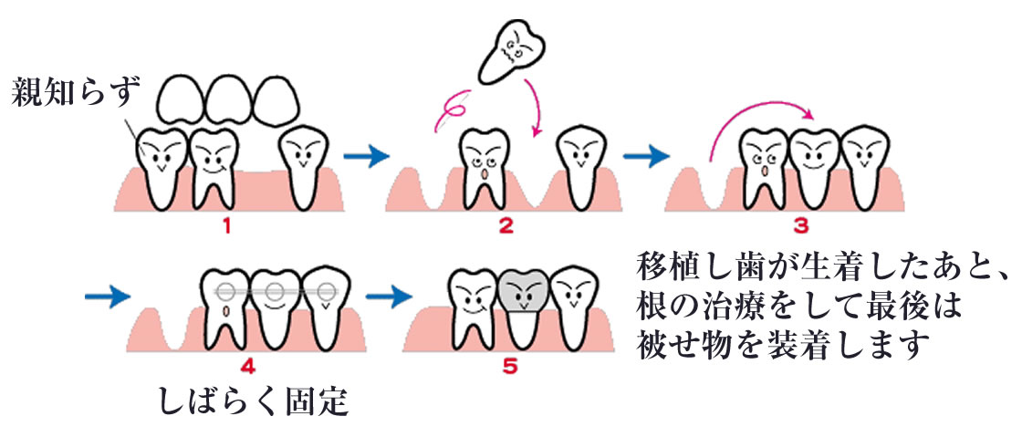 自家歯牙移植