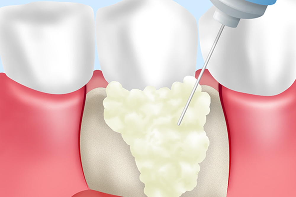 歯周組織再生療法にも対応